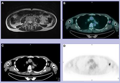 Progressive Encephalomyelitis with Rigidity and Myoclonus Associated With Anti-GlyR Antibodies and Hodgkin’s Lymphoma: A Case Report